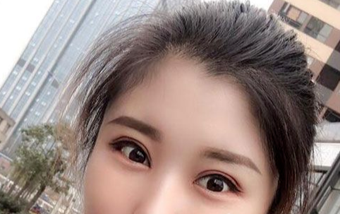 全切雙眼皮多長(zhǎng)時(shí)間恢復(fù)自然？