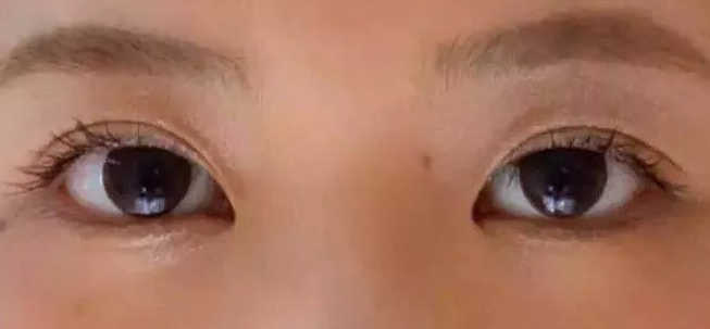 全切雙眼皮術(shù)后會疼幾天？