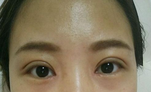 全切雙眼皮術(shù)后會留疤嗎？
