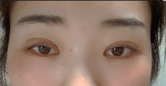 什么是全切雙眼皮？全切雙眼皮的恢復(fù)時(shí)間？