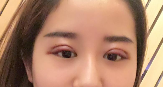 全切雙眼皮好不好？全切雙眼皮多長時間恢復(fù)自然？