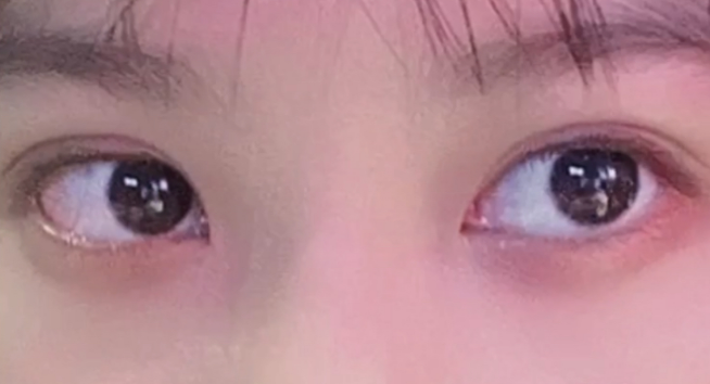 全切雙眼皮有哪些壞處？