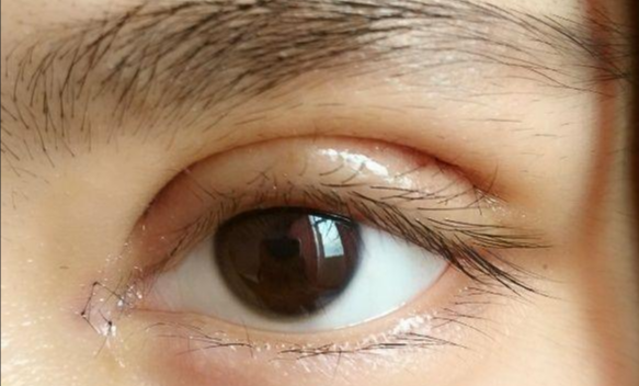 全切雙眼皮會(huì)留疤嗎？全切雙眼皮的優(yōu)缺點(diǎn)？