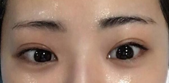 全切雙眼皮適合哪些人？