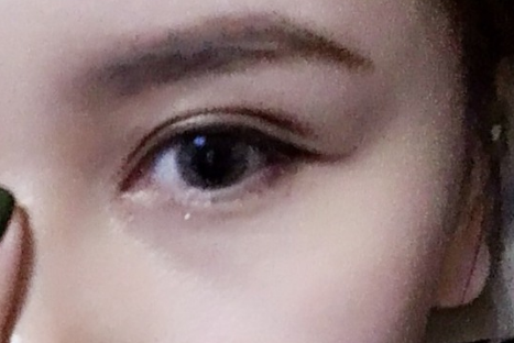 全切雙眼皮多久恢復好可以看到效果？全切雙眼皮需要多少錢？