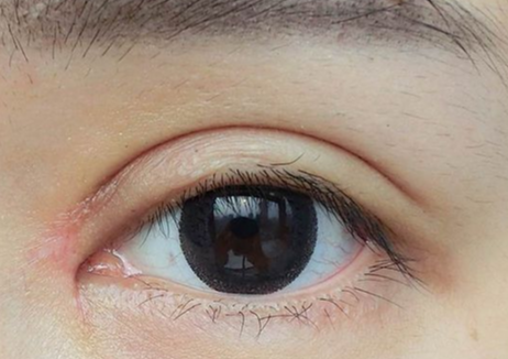什么是雙眼皮全切？全切雙眼皮拆線多久恢復(fù)？