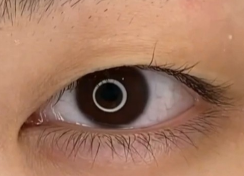 全切雙眼皮疤痕多久能消失？全切雙眼皮幾天可以洗臉？