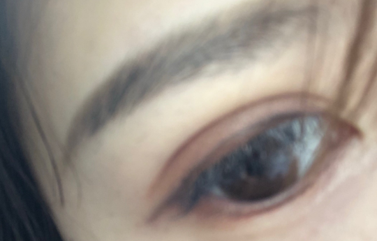 埋線雙眼皮疼嗎？埋線雙眼皮手術(shù)優(yōu)勢(shì)有哪些？