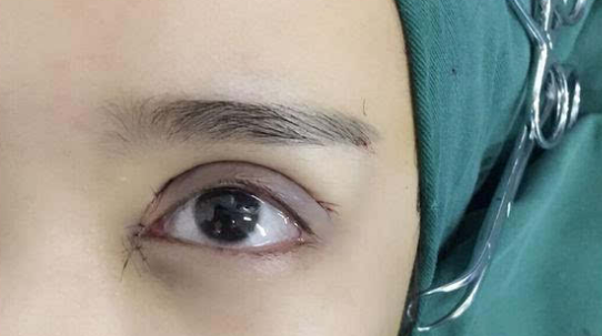 埋線雙眼皮會不會脫線？