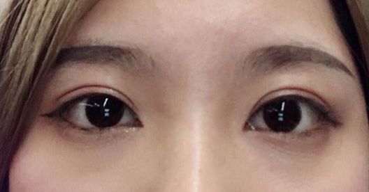 埋線雙眼皮幾天可以碰水？