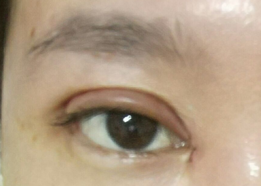 埋線雙眼皮可以維持幾年？