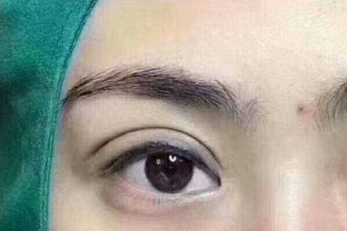 埋線雙眼皮貴不貴？