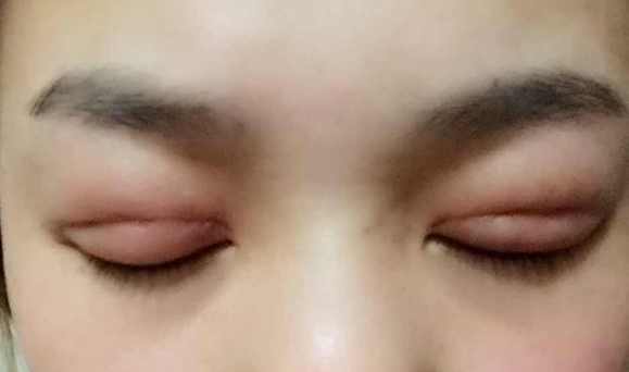 埋線雙眼皮幾天能消腫？