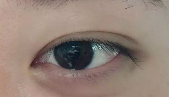 埋線雙眼皮有沒(méi)有危害？