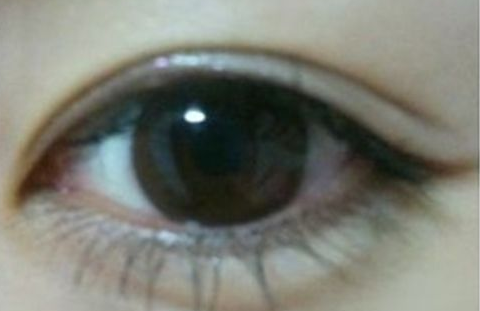 雙眼皮埋線怎么消腫快？埋線雙眼皮手術(shù)后有禁忌嗎？