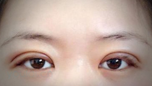 定點(diǎn)雙眼皮幾天能恢復(fù)好？定點(diǎn)做雙眼皮多少錢？