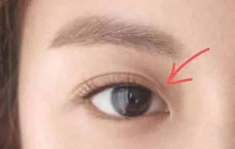 定點(diǎn)雙眼皮多久可以化妝？定點(diǎn)雙眼皮一般多少錢？