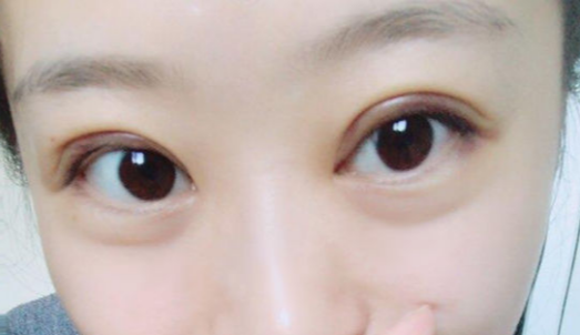 定點(diǎn)雙眼皮能維持幾年？