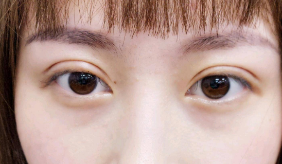 定點(diǎn)雙眼皮是什么意思？雙眼皮定點(diǎn)能維持多久？