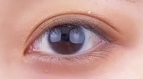 定點(diǎn)雙眼皮多少錢？