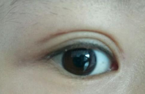 定點雙眼皮是怎么做的？