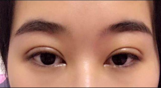 單眼皮割雙眼皮風(fēng)險大嗎？