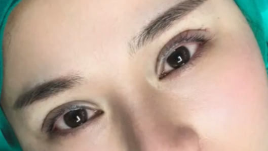 40歲做埋線雙眼皮的效果好不好？