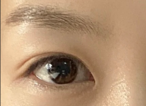 割雙眼皮后自然嗎？割雙眼皮后有危害嗎？