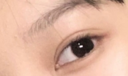 割雙眼皮恢復(fù)需要多久？