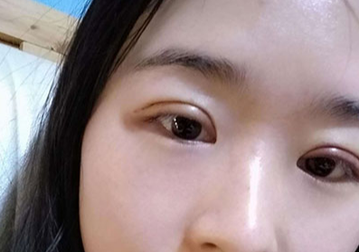 割雙眼皮后眼睛會變大嗎？