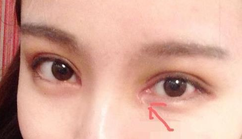 單眼皮開內(nèi)眼角會(huì)留疤嗎？