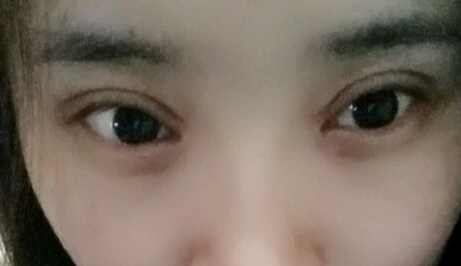 開眼角疼嗎？