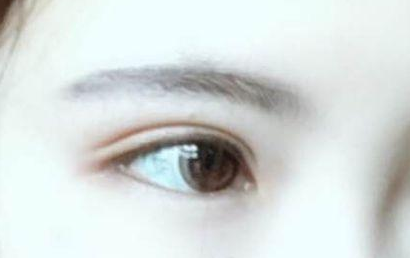 開眼角的恢復(fù)期多長？開眼角的后遺癥都有什么？