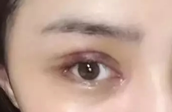 韓式開眼角失敗了怎么辦？