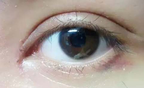 韓式開(kāi)眼角好嗎？韓式開(kāi)眼角術(shù)后怎么護(hù)理？