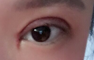 韓式開眼角手術(shù)有哪些優(yōu)勢？