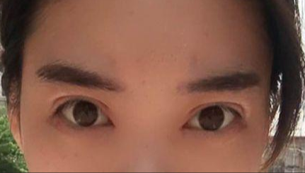 韓式開眼角的有副作用嗎？