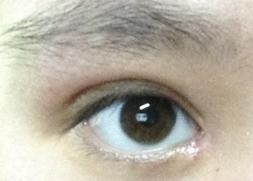 韓式開眼角的效果怎么樣？韓式開眼角失敗了怎么辦？