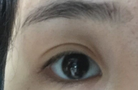 開(kāi)內(nèi)眼角拆線后變化明顯嗎？開(kāi)內(nèi)眼角會(huì)不會(huì)留疤？