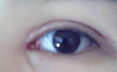 開(kāi)外眼角拆線疼嗎？