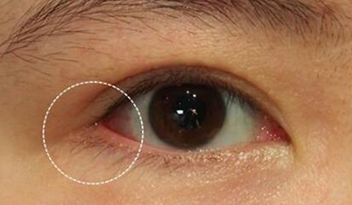 開內(nèi)眼角可能會出現(xiàn)什么后遺癥？