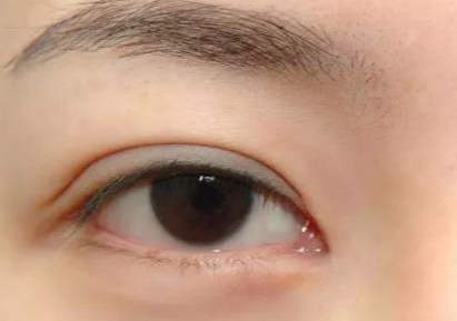 開內(nèi)外眼角多久能恢復(fù)好？開內(nèi)外眼角多少錢？