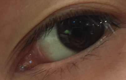 開眼角大概多少錢？開外眼角效果好不好？