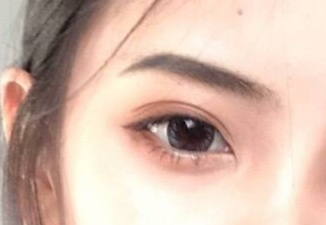 開內(nèi)外眼角的恢復(fù)期是多久？術(shù)后后遺癥有哪些？