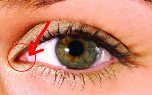 開內(nèi)眼角手術(shù)有什么效果？