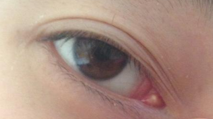 開(kāi)內(nèi)外眼角的方法有哪些？