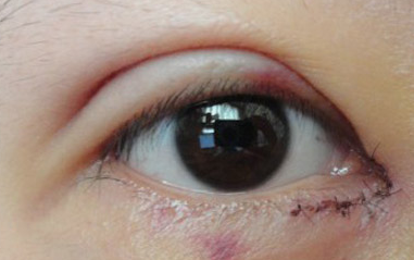 開內(nèi)眼角過程中會疼嗎？開內(nèi)眼角的風(fēng)險有哪些？