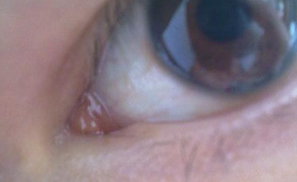 開內(nèi)外眼角需要注意什么？