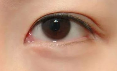 開內(nèi)眼角的優(yōu)缺點(diǎn)有哪些？
