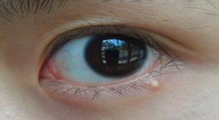 開內(nèi)外眼角手術(shù)是永久的嗎？